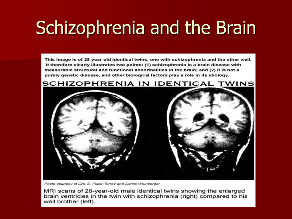 Understanding the brain disorder schizophrenia